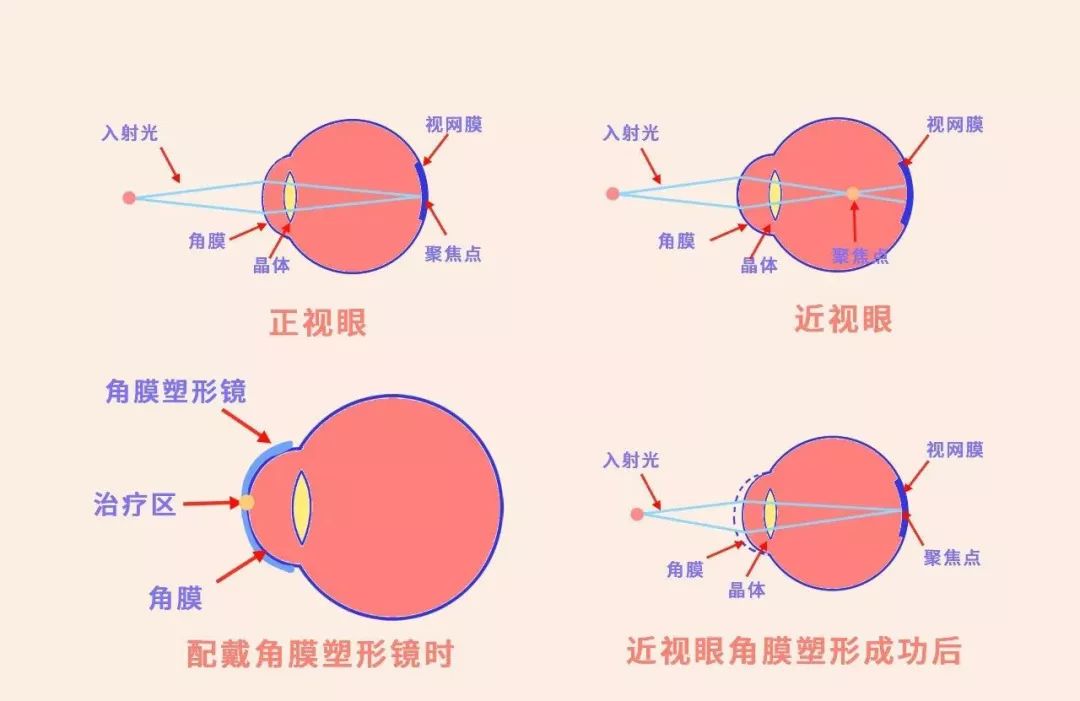 近视是因为光线通过眼